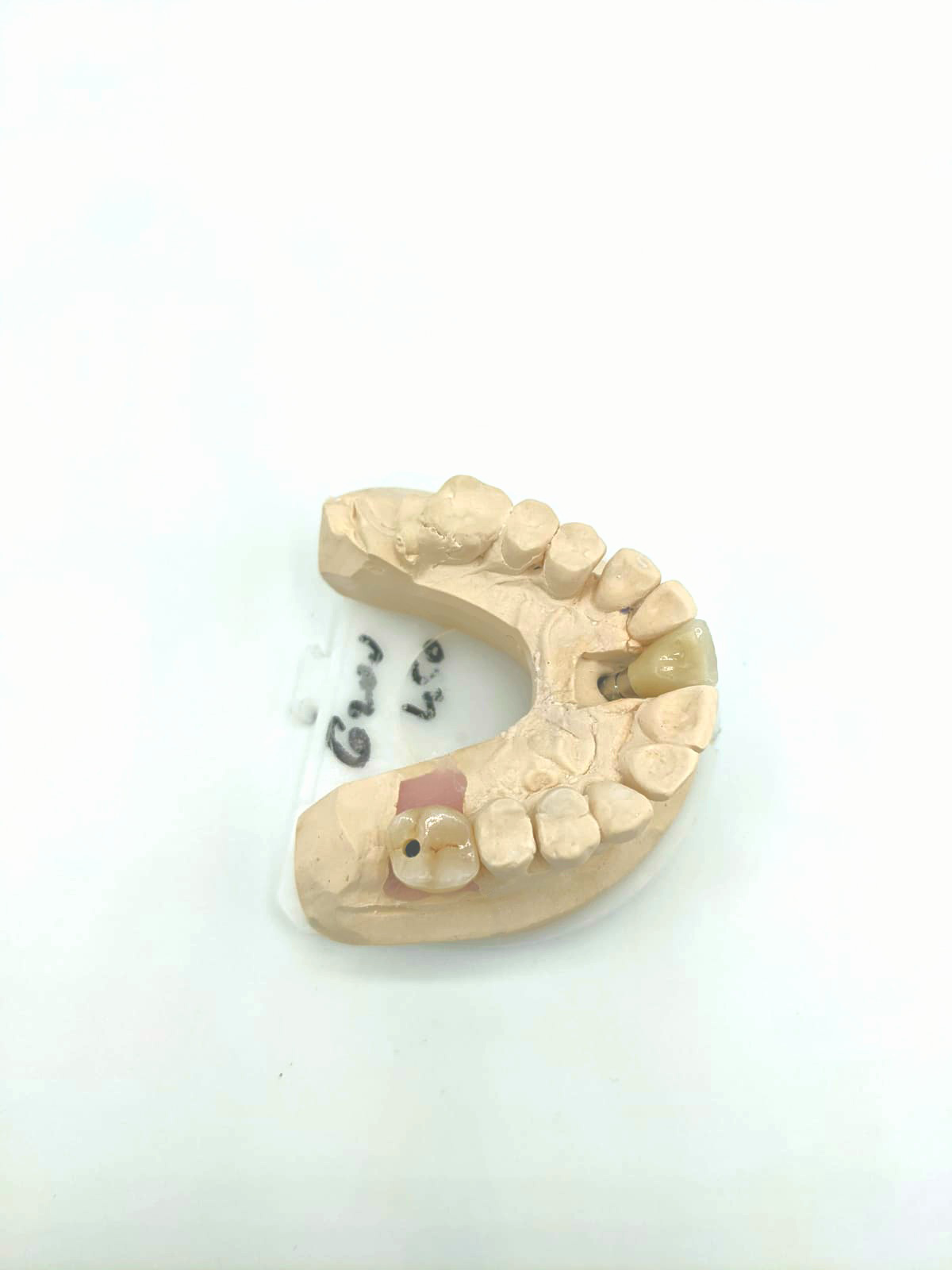 Dentaire365 - Scellement d'une couronne en zircone monolithique