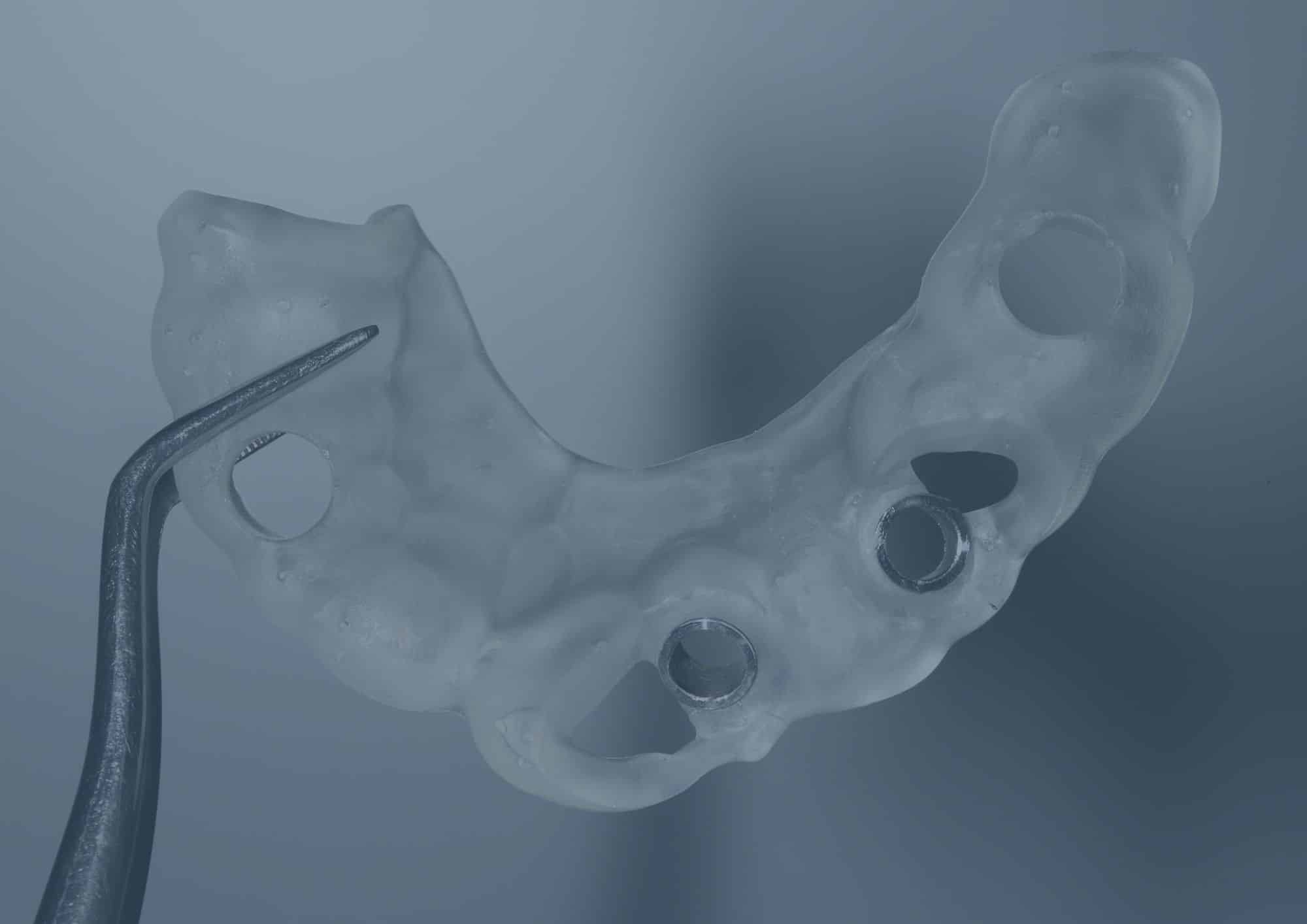 Guides chirurgicaux imprimés en 3D - Laboratoire dentaire Cristal